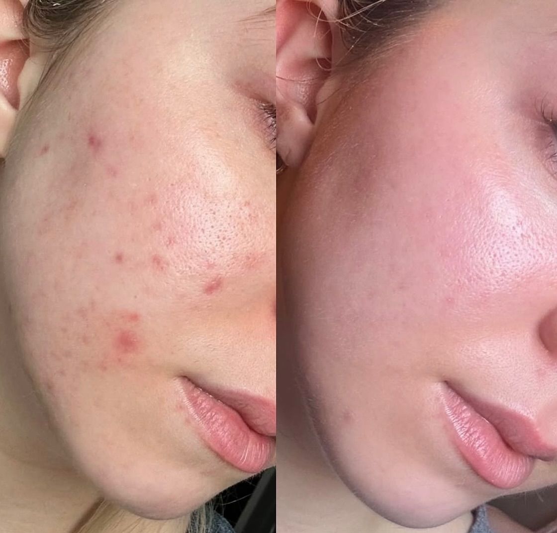 Profesyonel Akne Tedavisi - 1