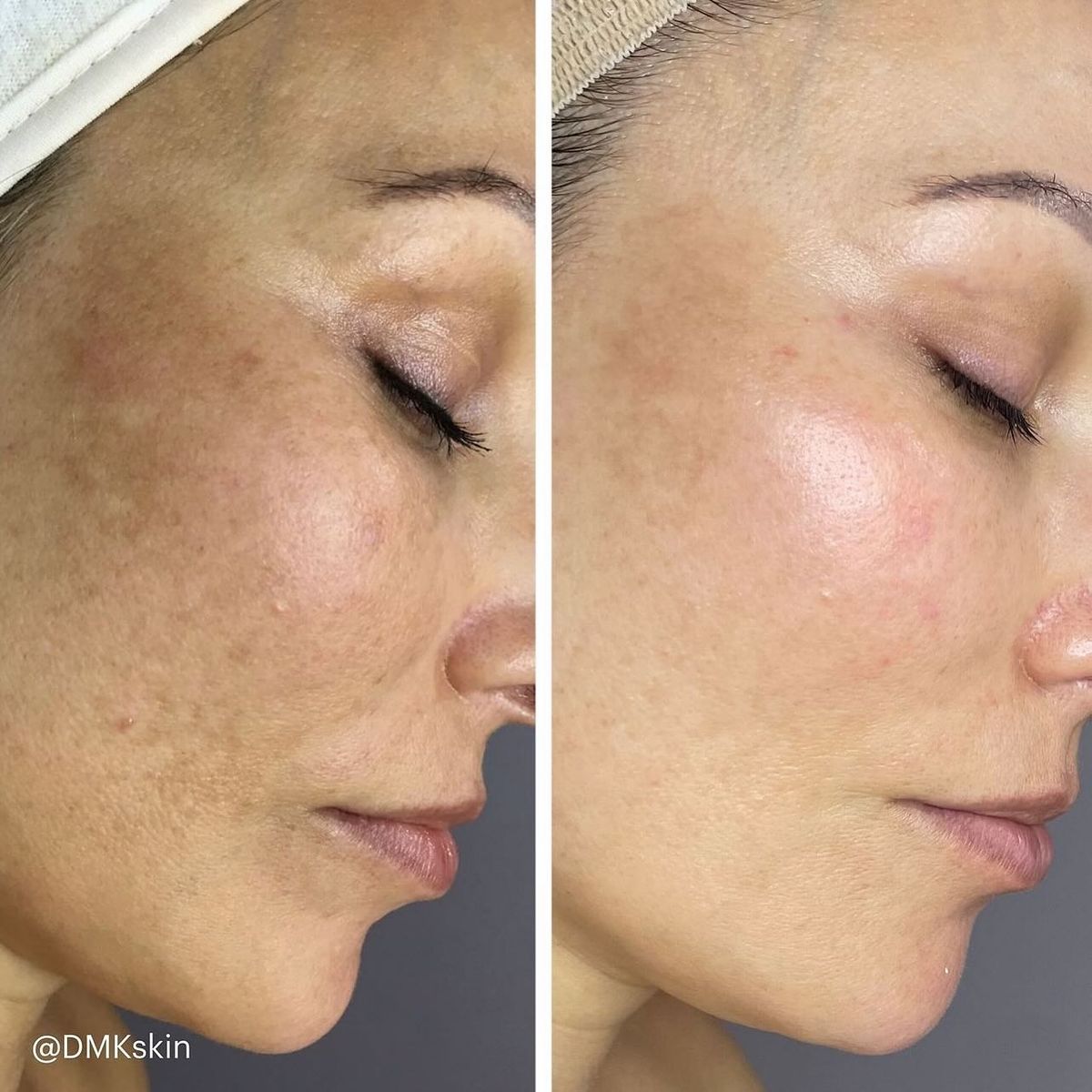 Profesyonel Akne Tedavisi - 3