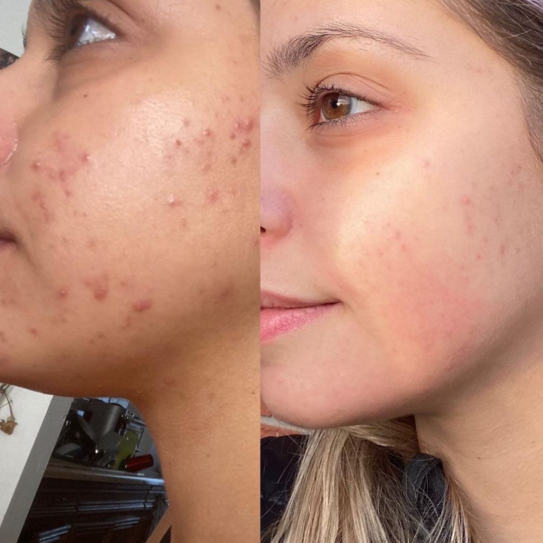 Profesyonel Akne Tedavisi - 4