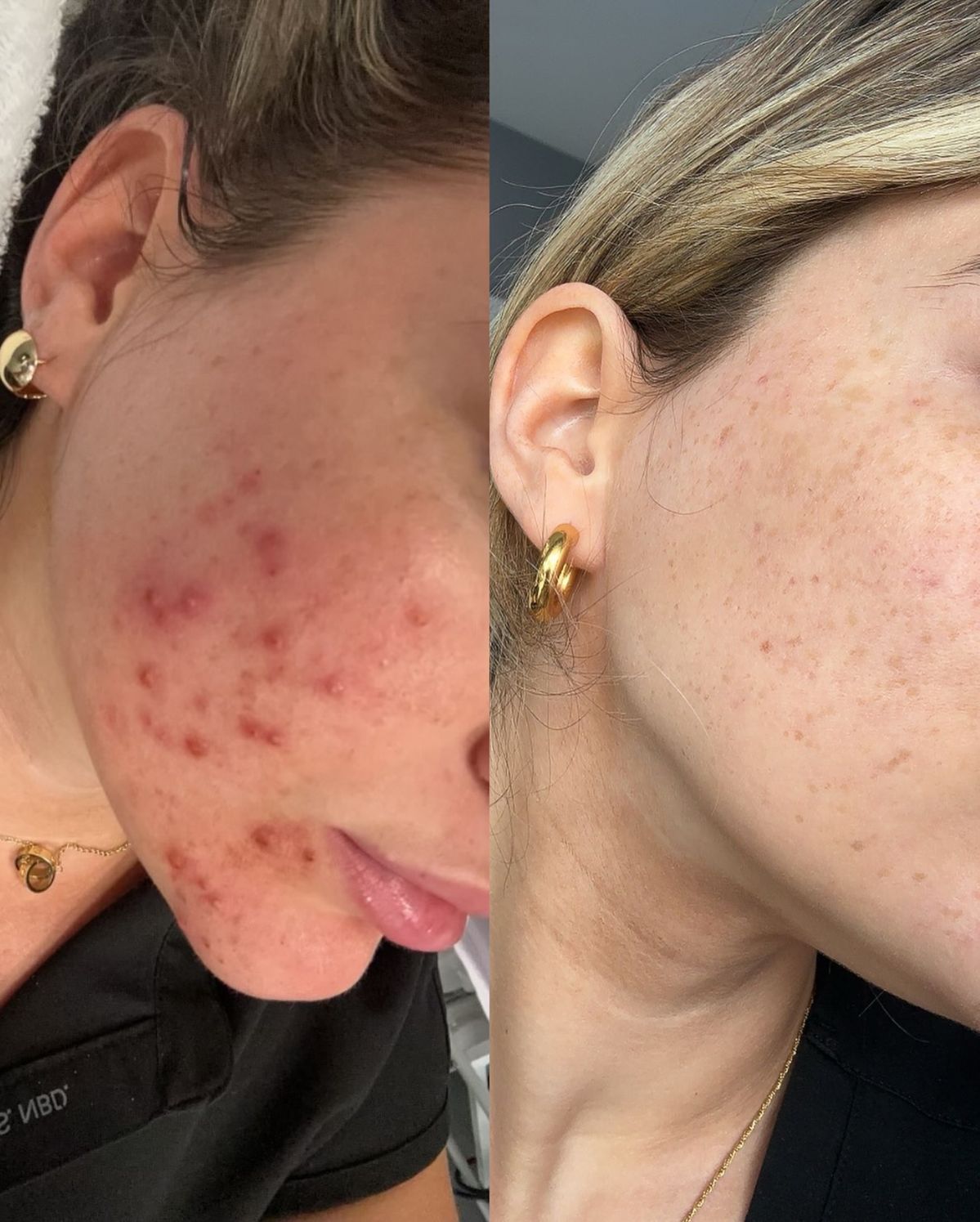 Profesyonel Akne Tedavisi - 5