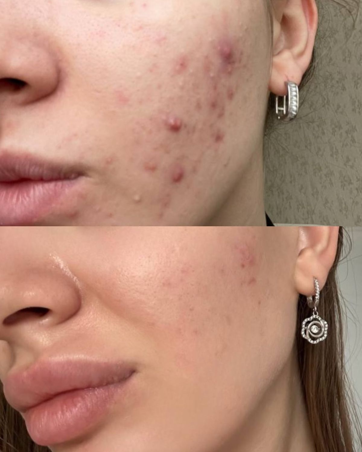 Profesyonel Akne Tedavisi - 6